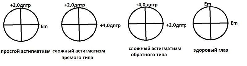 Гиперметропический астигматизм обоих. Астигматизм миопический простой обратный. Астигматизм (виды, принципы коррекции).. Сложный миопический прямой астигматизм. Сложный обратный гиперметропический астигматизм.