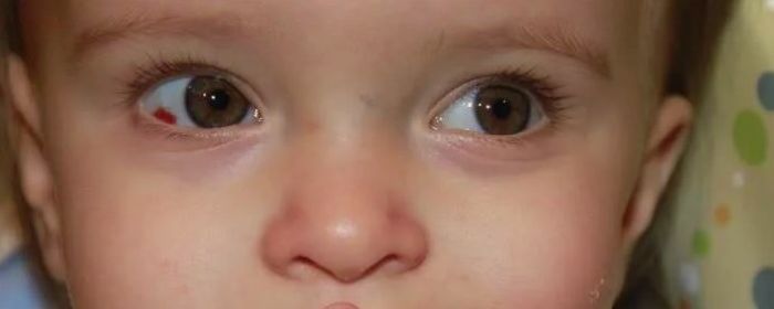 Ребенок с кровоизлиянием в глазу