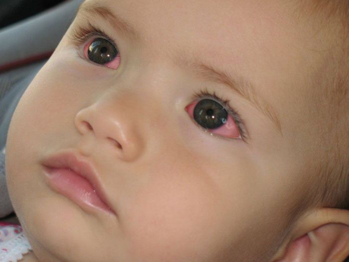 Малыш с красными глазами
