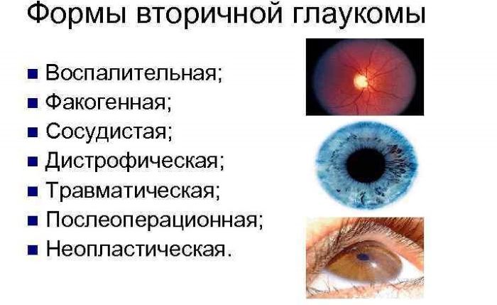 Вторичная глаукома