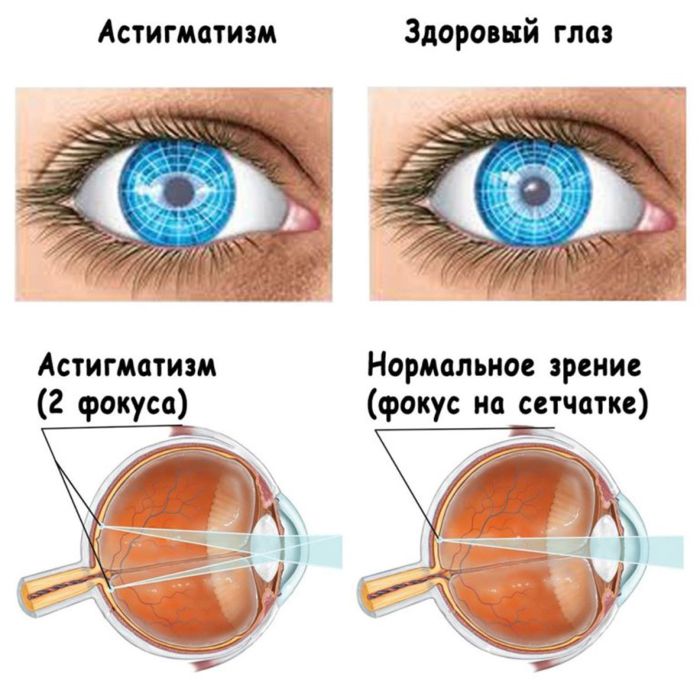 Патология зрения